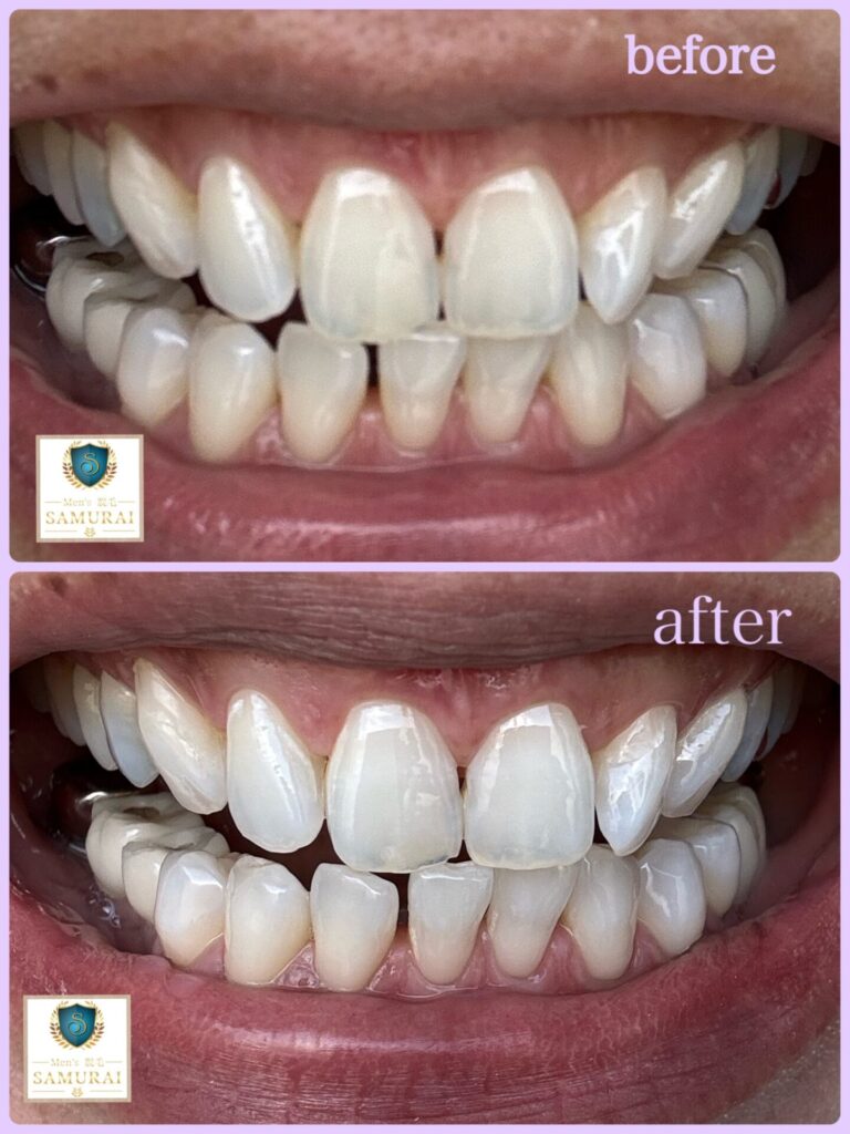 おすすめ②_PkoL福利厚生_レディース&メンズ脱毛 SAMURAI 那覇市店